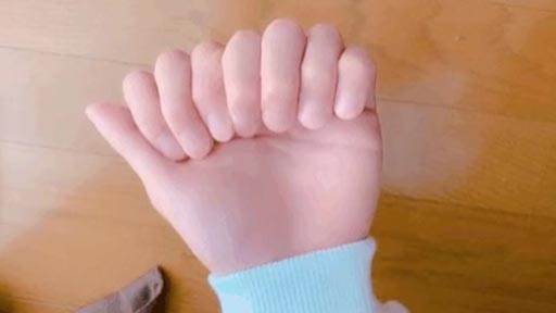 8 dedos en la mano